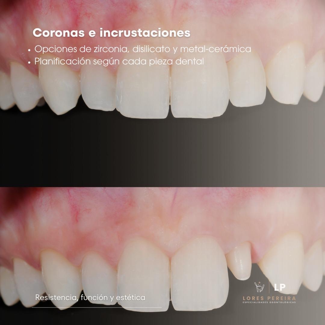 Estética Dental y Restauradora en Lores Pereira - Especialidades Odontológicas