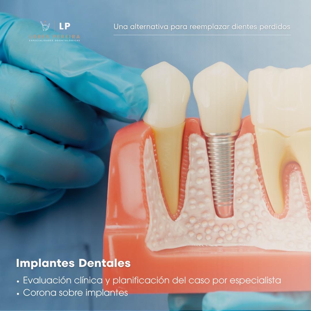 Implante Dental en Lores Pereira - Especialidades Odontológicas